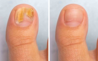 Lasersko uklanjanje gljivica: Učinkovito rješenje za zdrave nokte