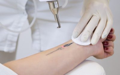 Prednosti laserskog uklanjanja tetovaža